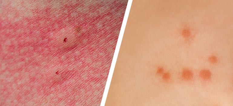 how to tell if it's a spider bite or bed bug bite