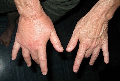Wasp sting treatment Wasp sting treatment